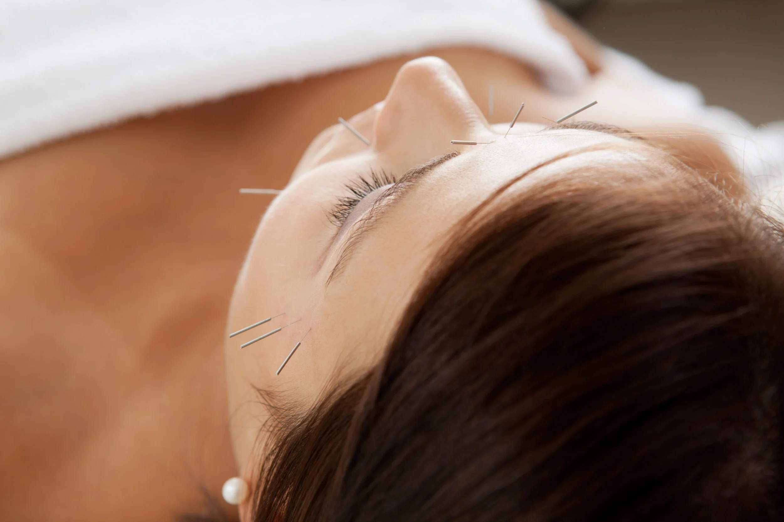 Facial rejuvenation acupuncture